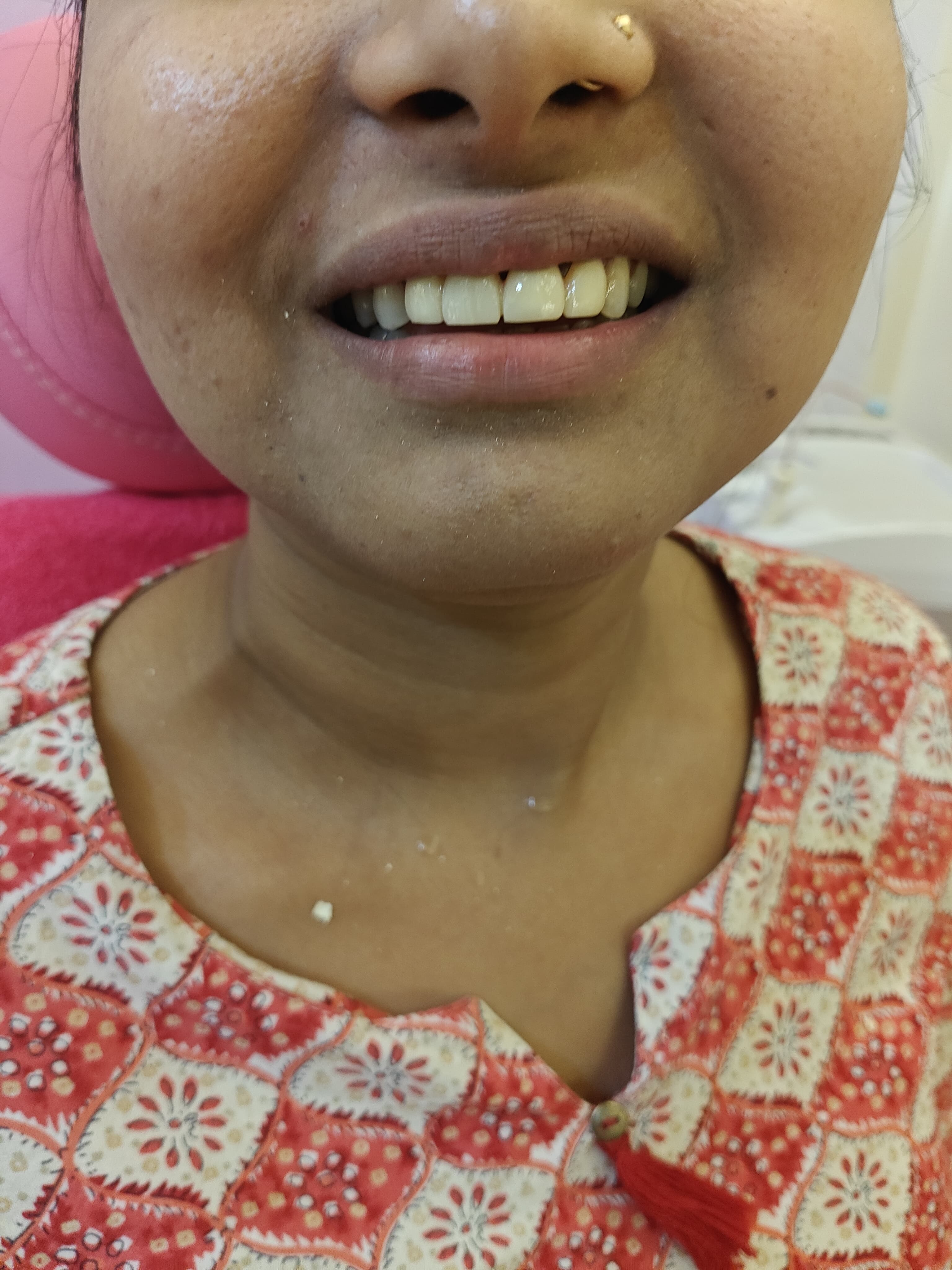 Smile Transformation Case 4